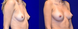 Right 3/4 View - Breast Augmentation