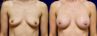 Frontal View - Breast Augmentation