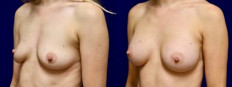 Left 3/4 View - Breast Augmentation