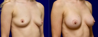 Right 3/4 View - Breast Augmentation