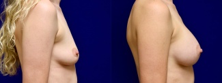 Right Profile View - Breast Augmentation