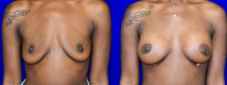 Frontal View - Breast Augmentation