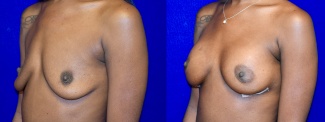 Left 3/4 View - Breast Augmentation