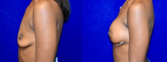 Left Profile View - Breast Augmentation