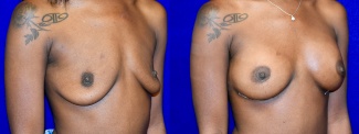 Right 3/4 View - Breast Augmentation