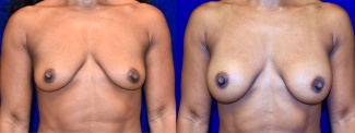 Frontal View - Breast Augmentation