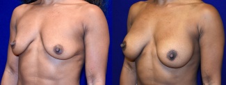 Left 3/4 View - Breast Augmentation