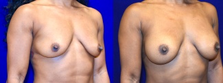 Right 3/4 View - Breast Augmentation