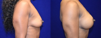 Right Profile View - Breast Augmentation