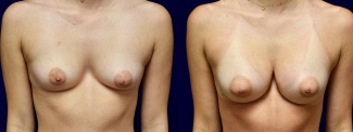 Frontal View - Breast Augmentation