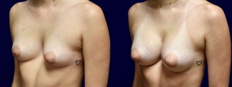 Left 3/4 View - Breast Augmentation