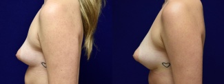 Left Profile View - Breast Augmentation