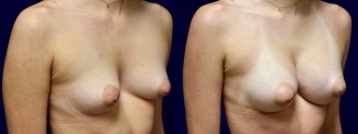 Right 3/4 View - Breast Augmentation