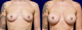 Frontal View - Breast Augmentation