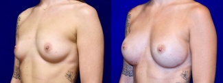 Left 3/4 View - Breast Augmentation