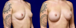 Right 3/4 View - Breast Augmentation