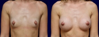 Frontal View - Breast Augmentation