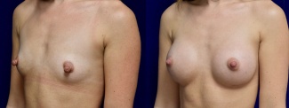 Left 3/4 View - Breast Augmentation