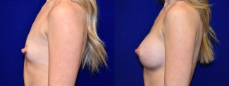 Left Profile View - Breast Augmentation