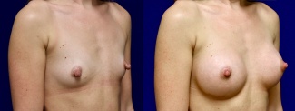 Right 3/4 View - Breast Augmentation