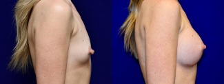 Right Profile View - Breast Augmentation