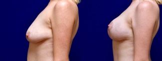 Left Profile View - Breast Augmentation with Lift