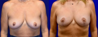 Frontal View - Breast Augmentation with Lift