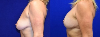 Left Profile View - Breast Augmentation with Lift