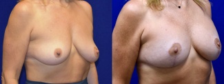 Right 3/4 View - Breast Augmentation with Lift