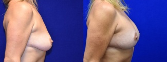 Right Profile View - Breast Augmentation with Lift