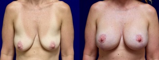 Frontal View - Breast Augmentation with Lift