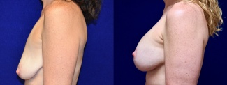 Left Profile View - Breast Augmentation with Lift