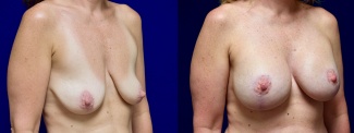 Right 3/4 View - Breast Augmentation with Lift
