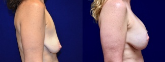 Right Profile View - Breast Augmentation with Lift