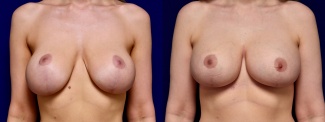 Frontal View - Breast Augmentation Revision with Galaflex