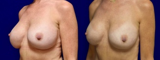 Left 3/4 View - Breast Augmentation Revision with Galaflex