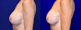 Left Profile View - Breast Augmentation Revision with Galaflex