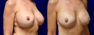 Right 3/4 View - Breast Augmentation Revision with Galaflex