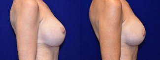 Right Profile View - Breast Augmentation Revision with Galaflex