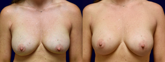 Frontal View - Breast Implant Revision with Galaflex