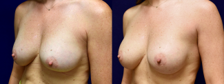 Left 3/4 View - Breast Implant Revision with Galaflex