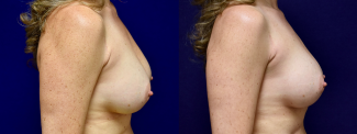 Right Profile View - Breast Implant Revision with Galaflex