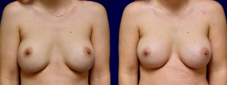Frontal View - Breast Augmentation Revision with Galaflex