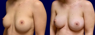 Left 3/4 View - Breast Augmentation Revision with Galaflex