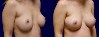 Right 3/4 View - Breast Augmentation Revision with Galaflex