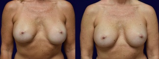 Frontal View - Breast Augmentation Revision with Galaflex