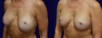 Left 3/4 View - Breast Augmentation Revision with Galaflex