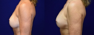 Left Profile View - Breast Augmentation Revision with Galaflex