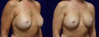 Right 3/4 View - Breast Augmentation Revision with Galaflex