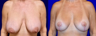 Frontal View - Breast Implant Revision and Breast Lift